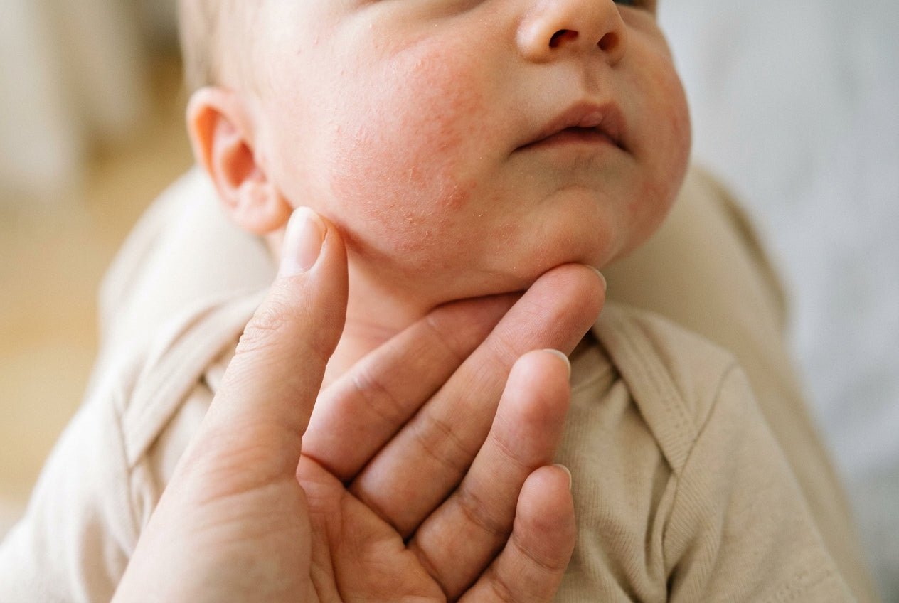 Milde Neurodermitis am Babygesicht mit trockener, leicht geröteter Wange