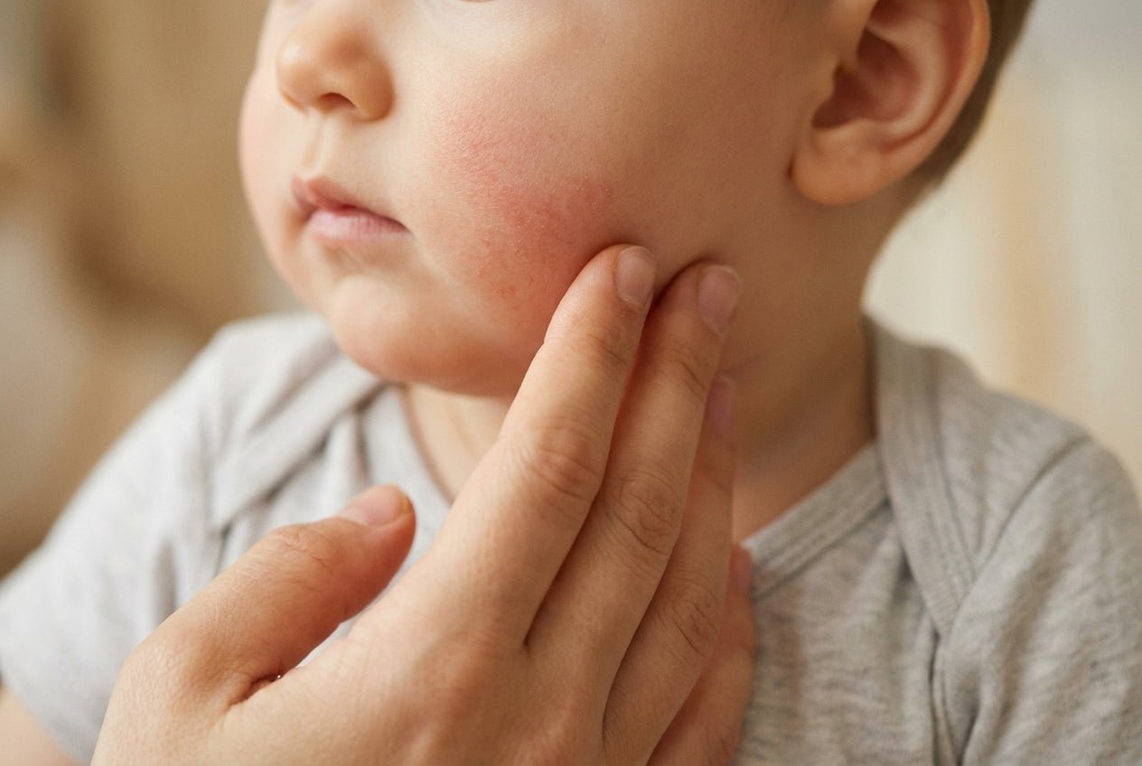 Milde Rötung und trockene Babyhaut an der Wange als mögliches Neurodermitis-Frühzeichen