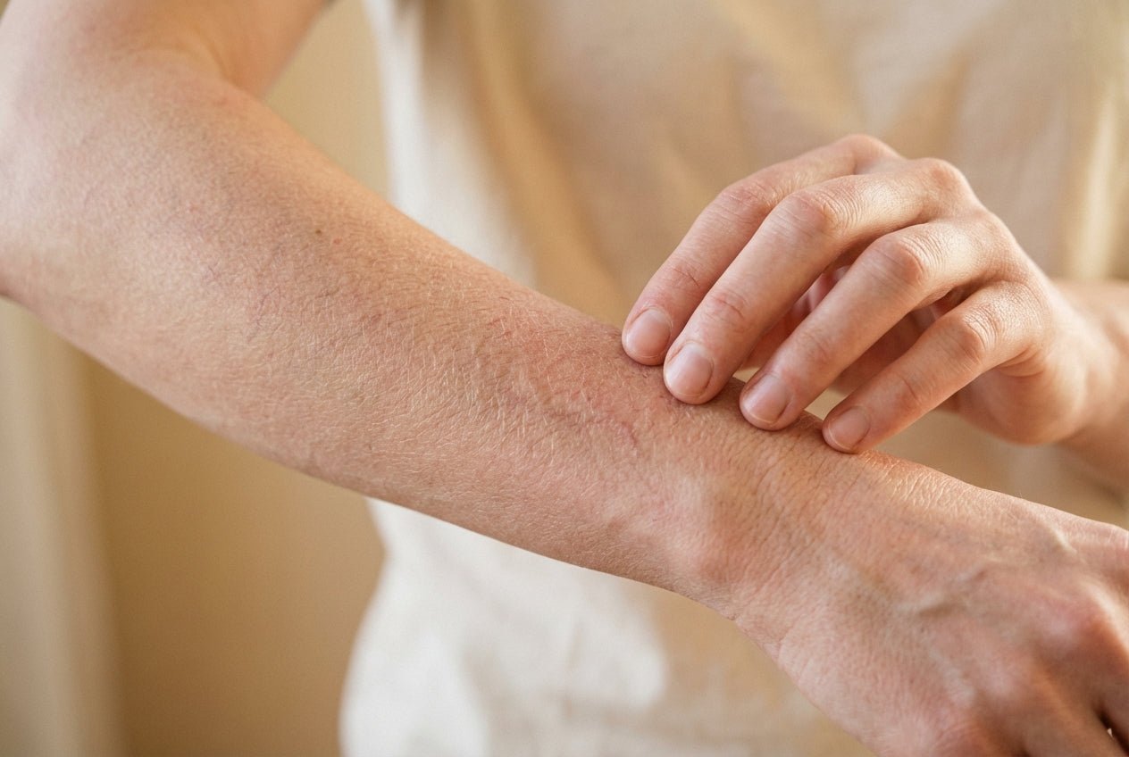 Milde Pergamenthaut durch Cortison am Unterarm mit feinen Knitterfältchen