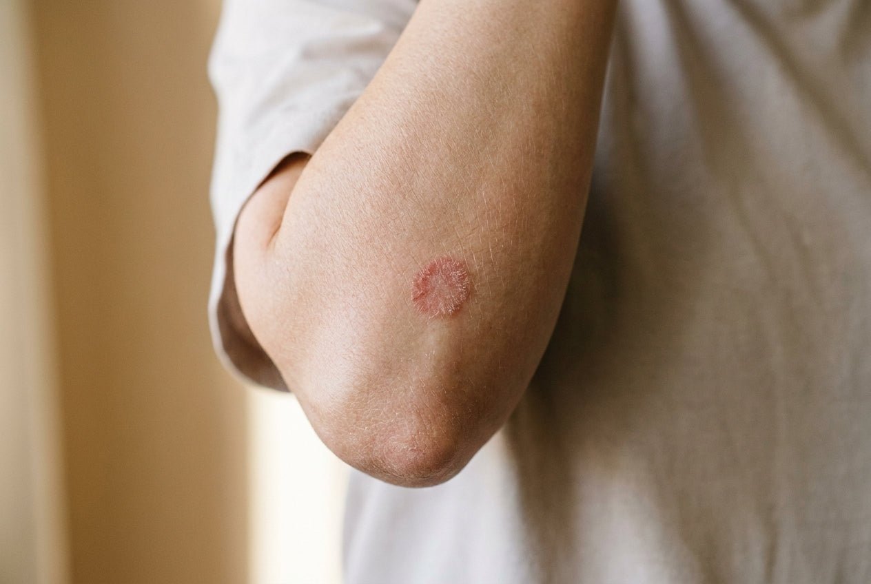 Beginnende Psoriasis am Ellbogen mit kleiner rötlicher Plaque und feiner Schuppung