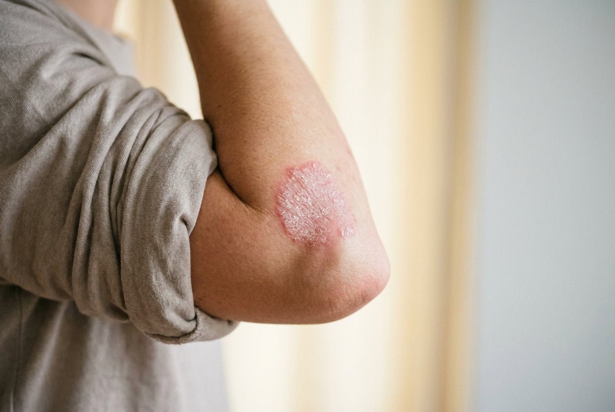 Milde Psoriasis-Plaque mit silbrig-weißen Schuppen an der Ellenbogen-Streckseite