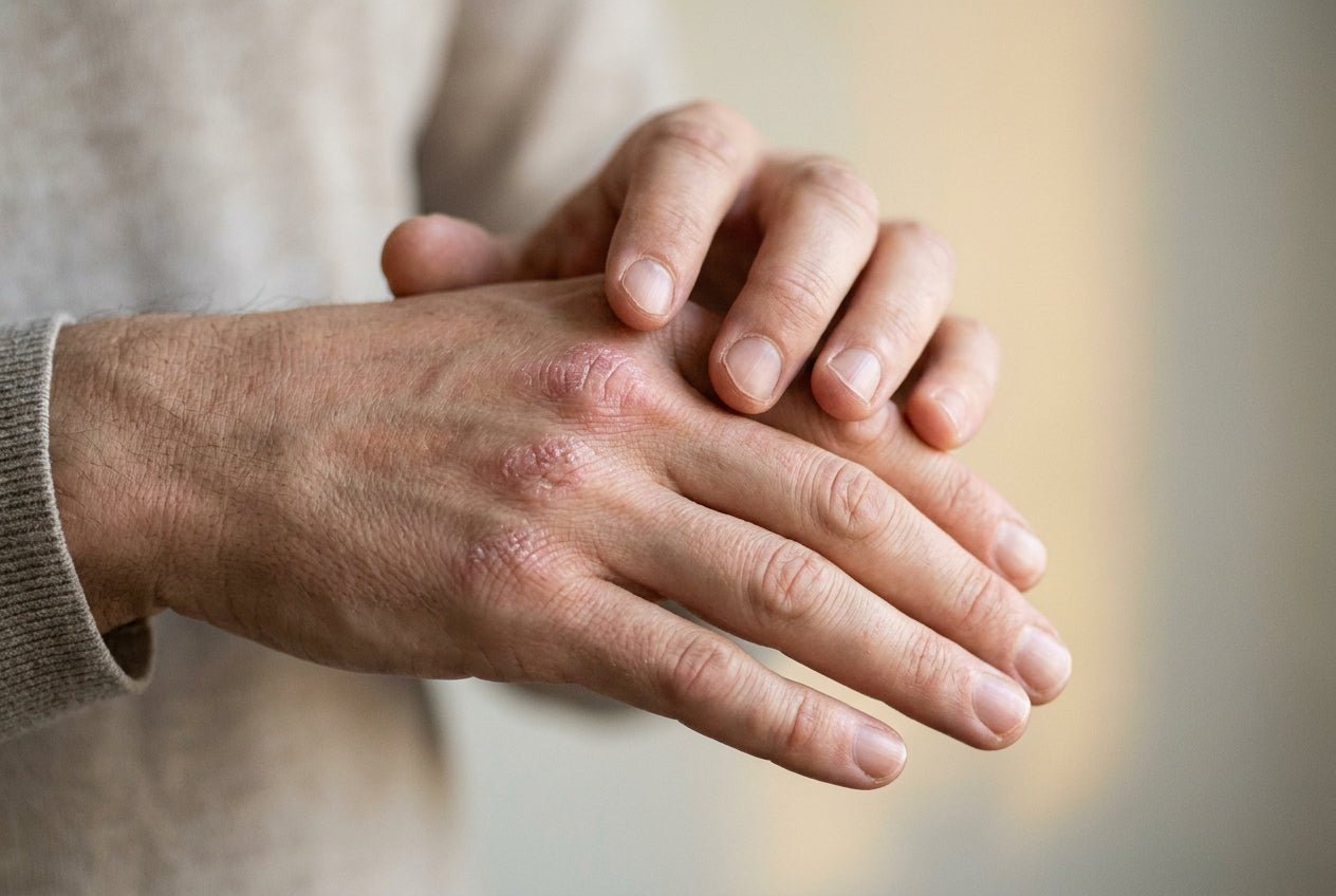 Milde Psoriasis an Fingerknöcheln mit Rötung und feiner Schuppung am Handrücken