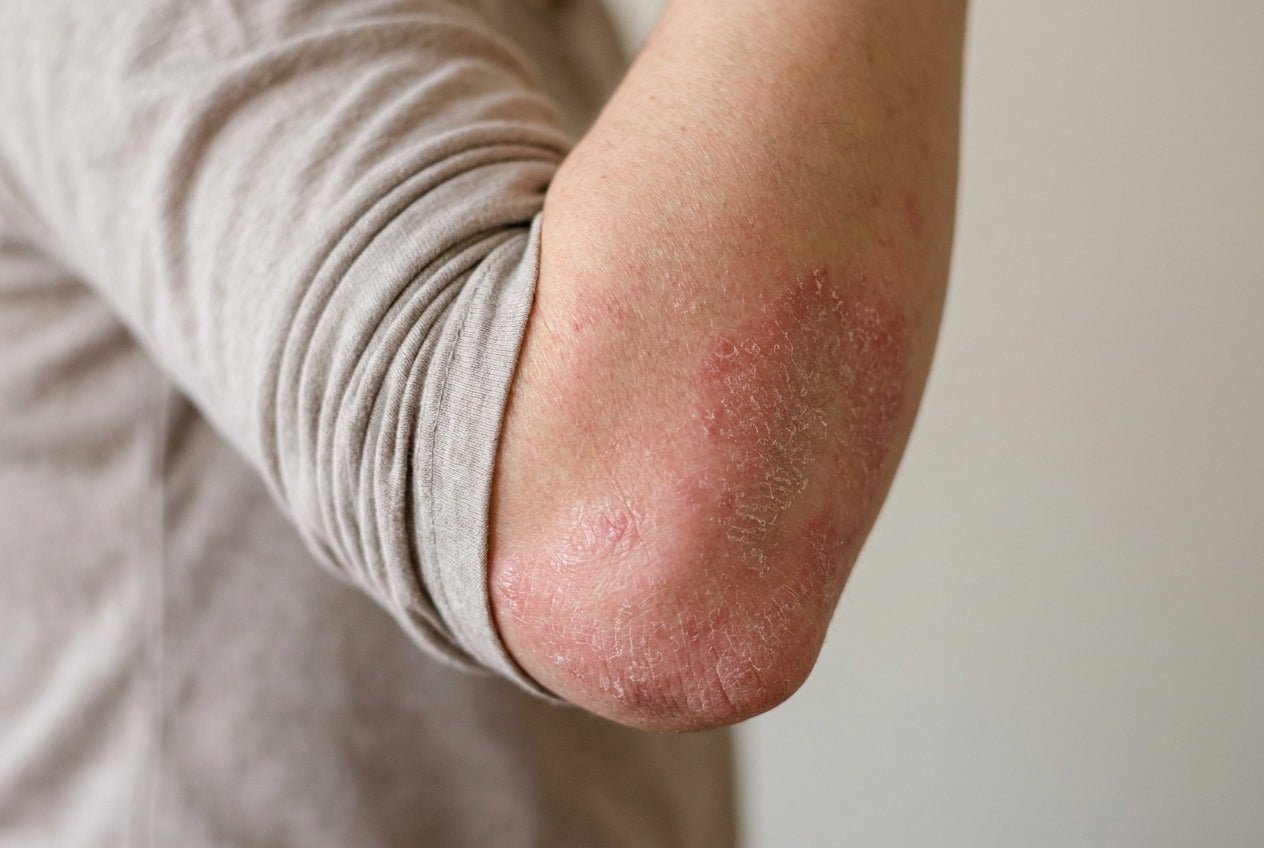 Milde Psoriasis-Plaque mit Rötung und Schuppung am Ellenbogen