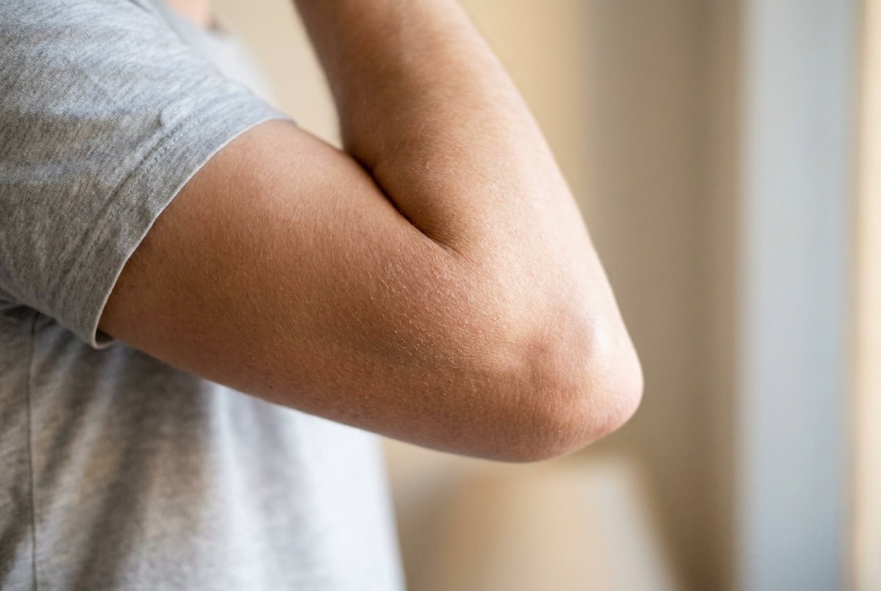 Milde trockene, schuppige Haut am Ellenbogen mit hochgeschobenem T-Shirt