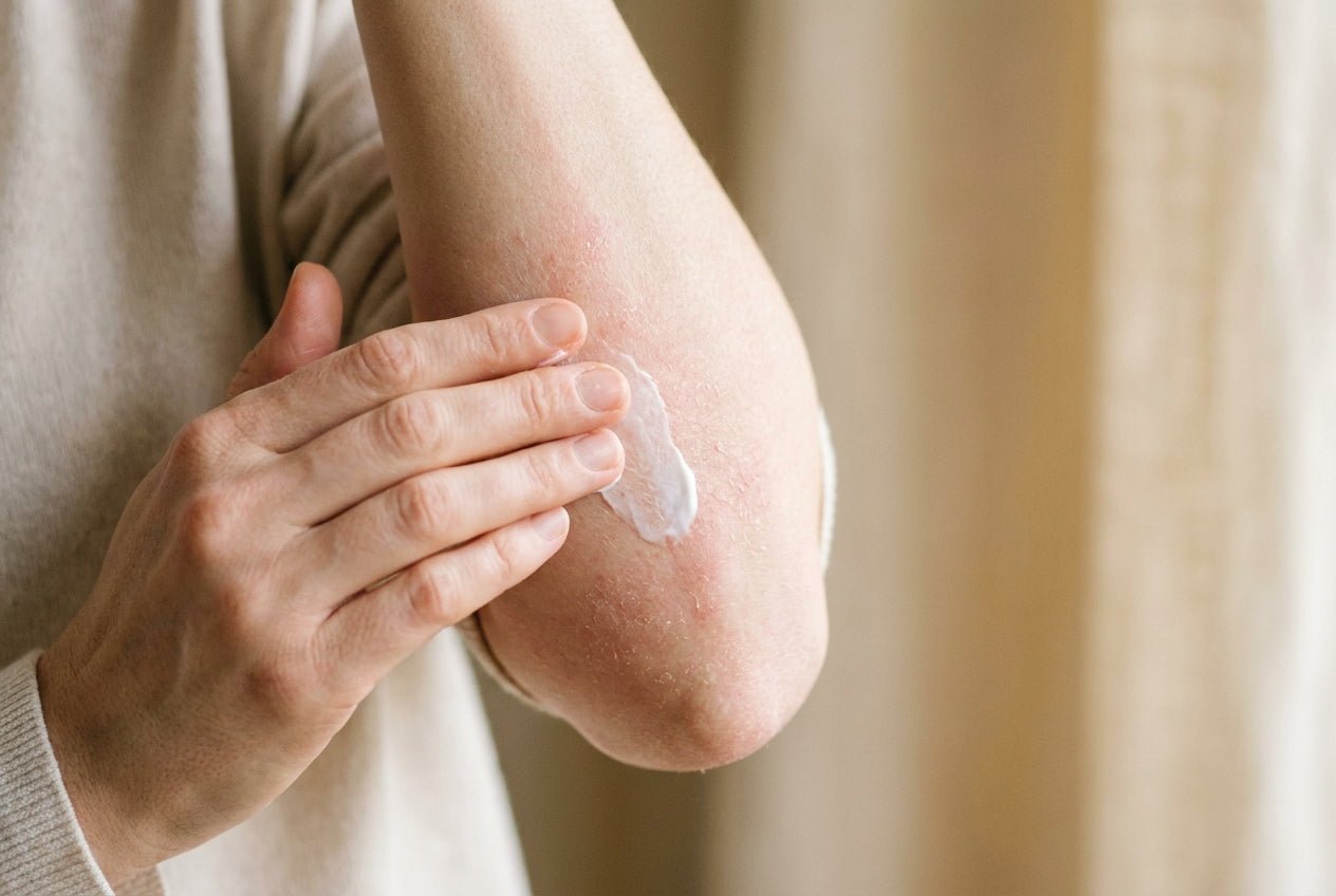 Milde Neurodermitis an der Armbeuge mit trockener Haut, Person cremt sanft ein