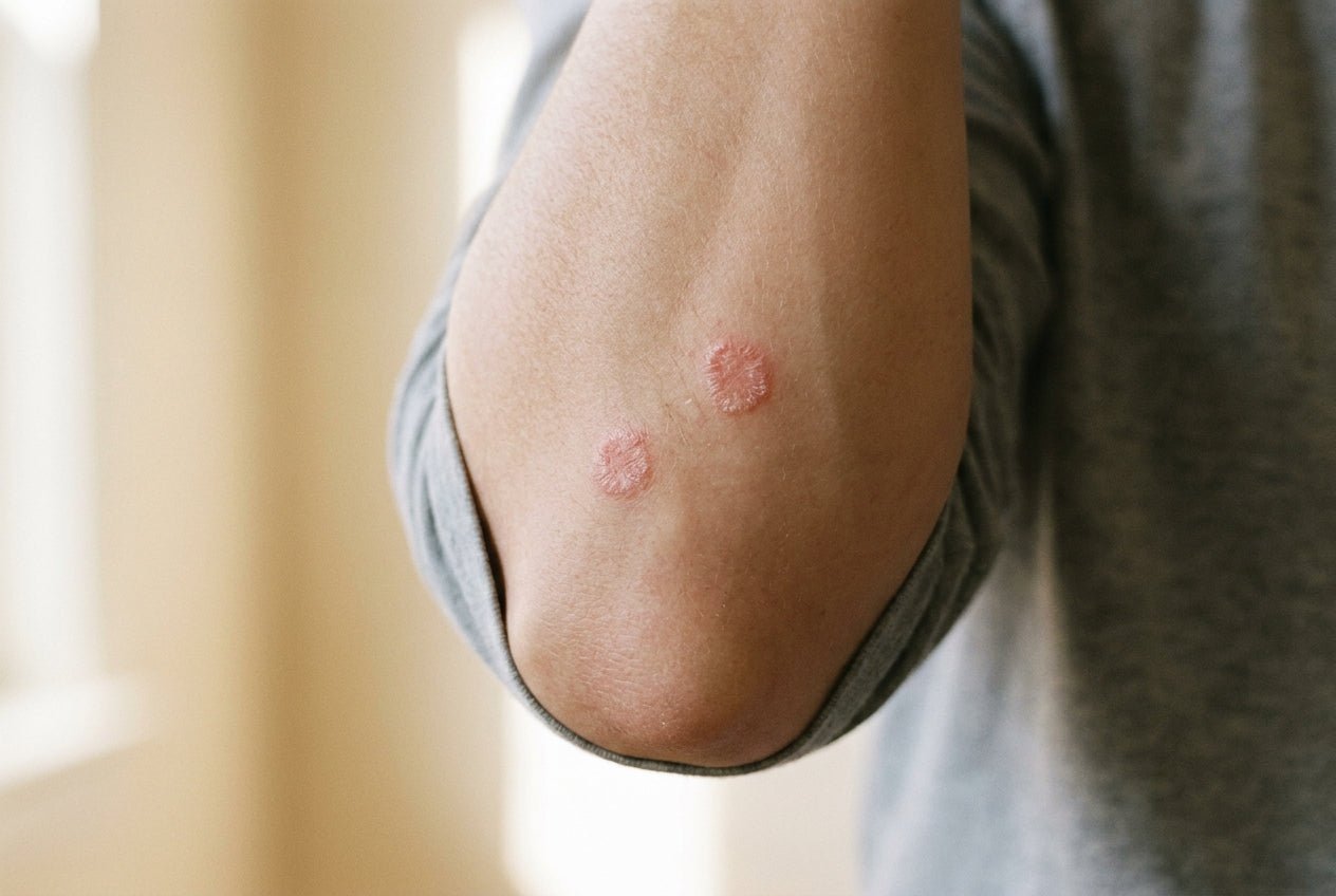 Milde Plaque-Psoriasis mit feiner Schuppung am Ellenbogen einer Person