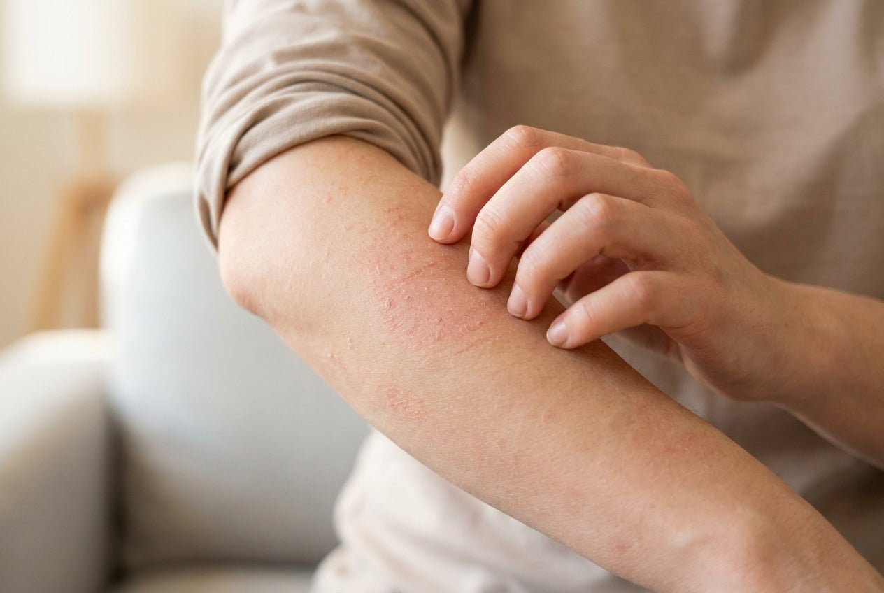 Milde Neurodermitis am Unterarm mit Rötung und trockener, schuppiger Haut