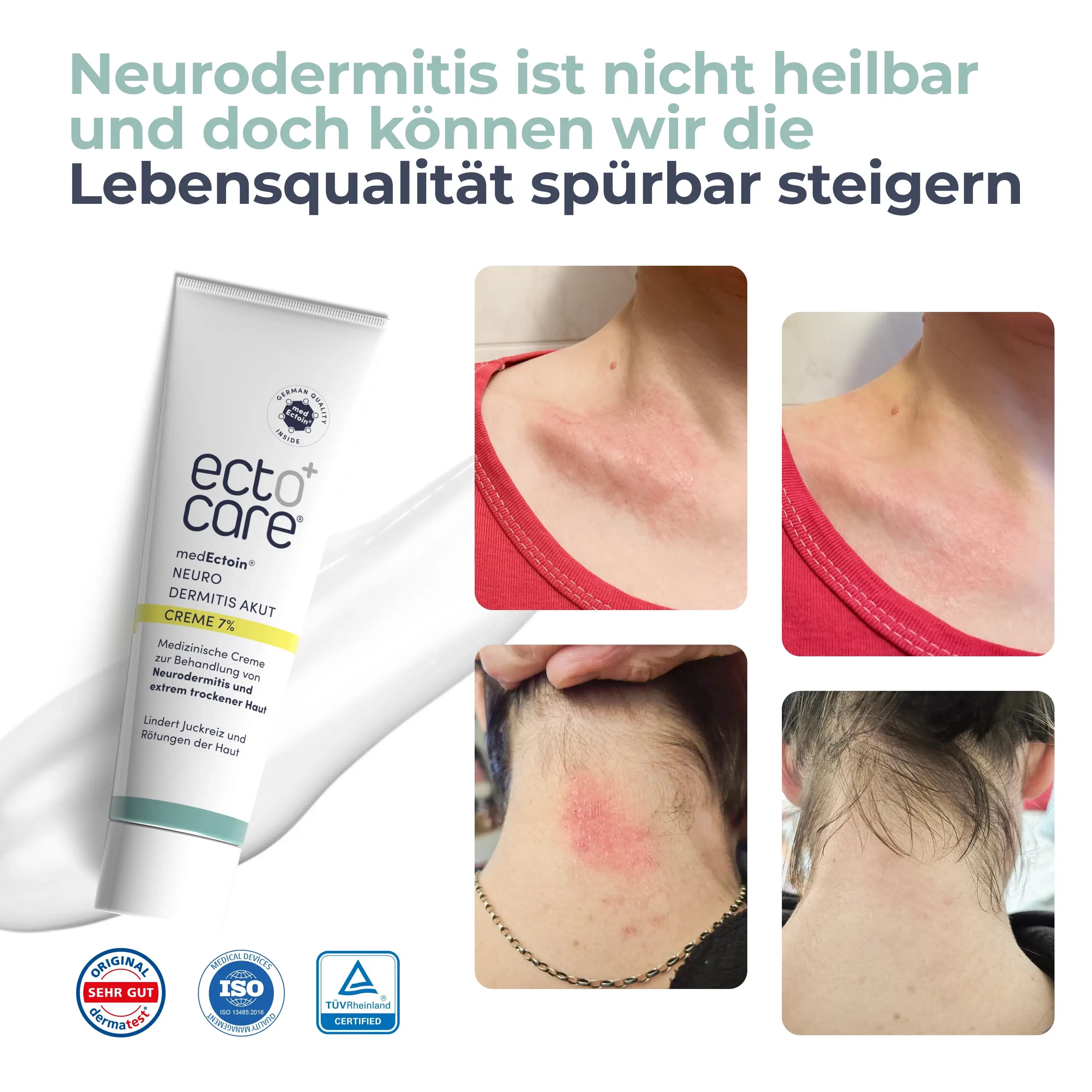 Vorher-Nachher-Bilder von Haut mit Neurodermitis. Links: Rötung und Irritation am Hals. Rechts: Haut sichtbar beruhigt und weniger gerötet. Text: 'Neurodermitis ist nicht heilbar und doch können wir die Lebensqualität spürbar steigern.'