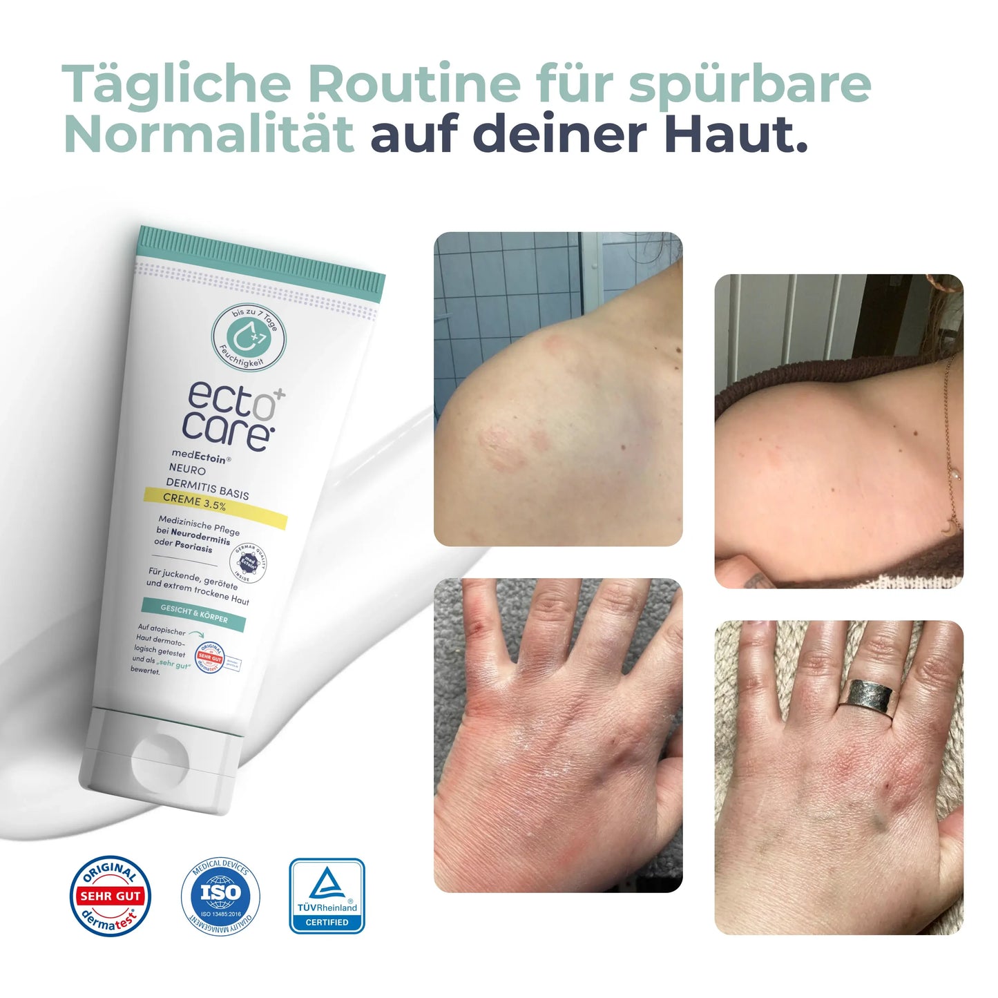 
                  
                    Vorher-Nachher-Vergleich der Hautpflege. Links ein Produkt von ecto+care, eine Creme in einer Tube. Rechts zwei Bilder von Haut mit Rötungen und trockenen Stellen.
                  
                