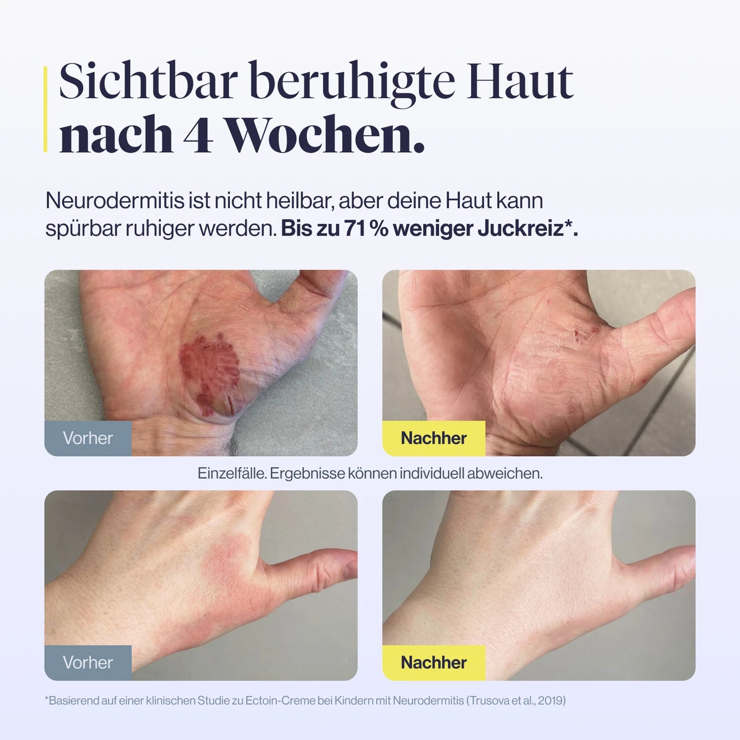 
                  
                    medEctoin® Neurodermitis Akut Creme 7% 50ml
                  
                