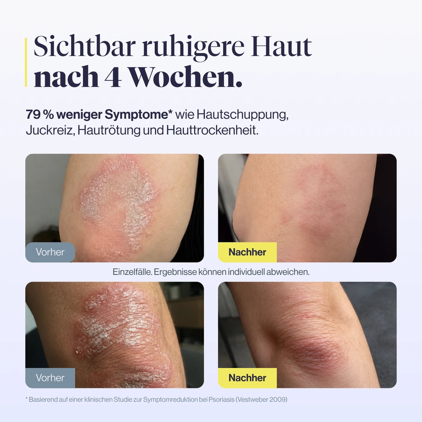 
                  
                    medEctoin® Psoriasis Akut Creme 5% 50ml
                  
                