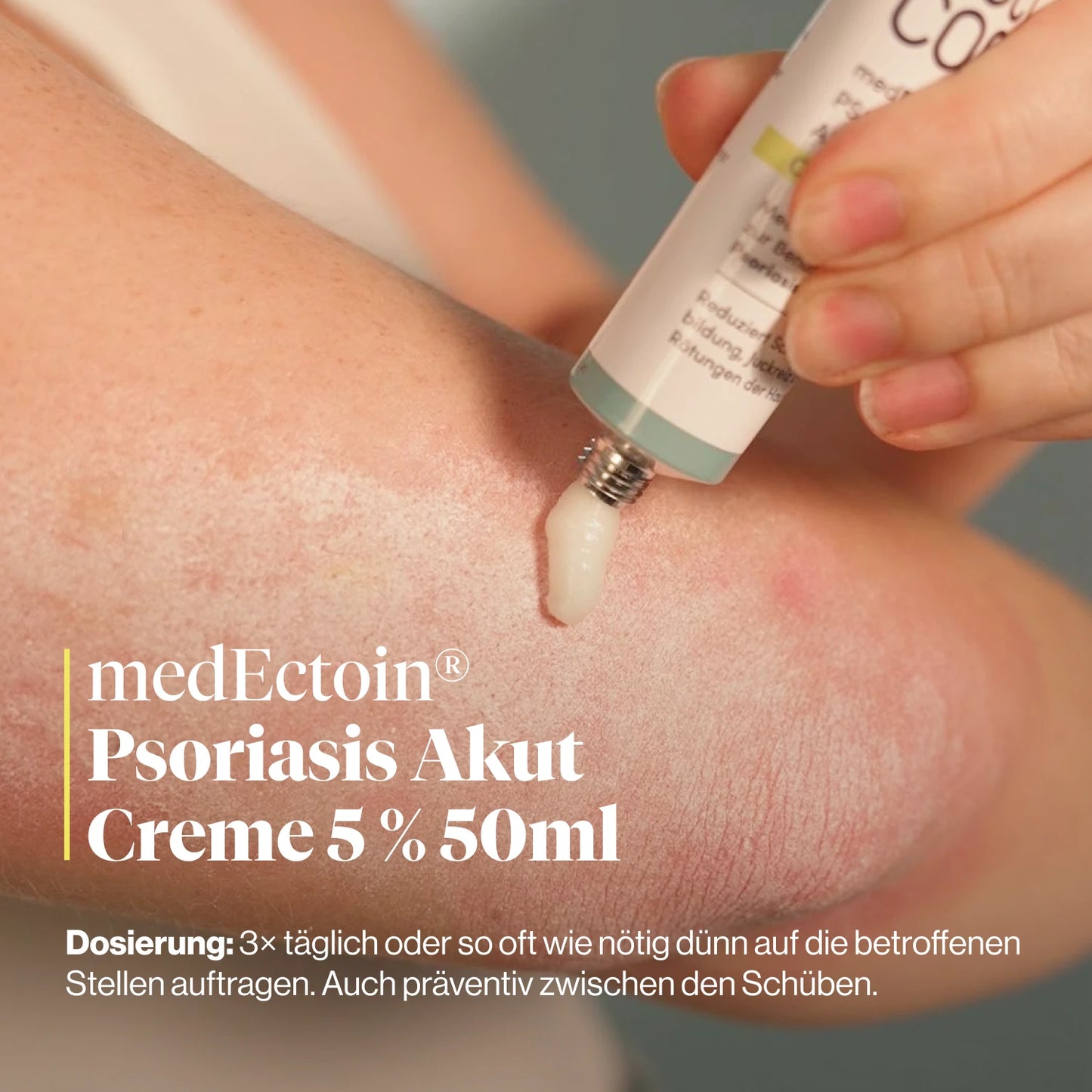 
                  
                    medEctoin® Psoriasis Akut Creme 5% 50ml
                  
                