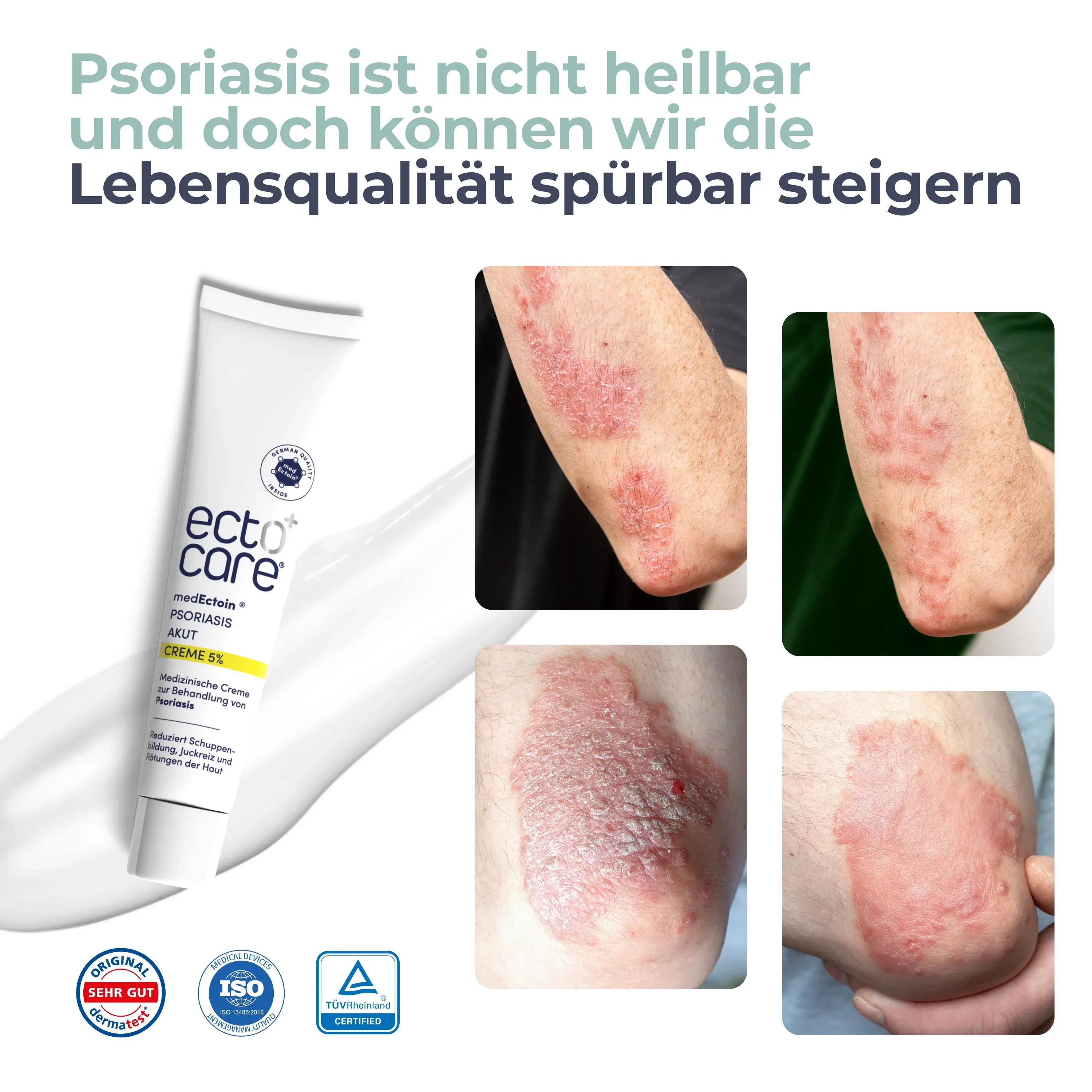 Vorher-Nachher-Bilder von Haut mit Psoriasis. Links: Rötung und Schuppenbildung an einem Ellenbogen. Rechts: Verbesserte Hauttextur und weniger Rötung an zwei Stellen.