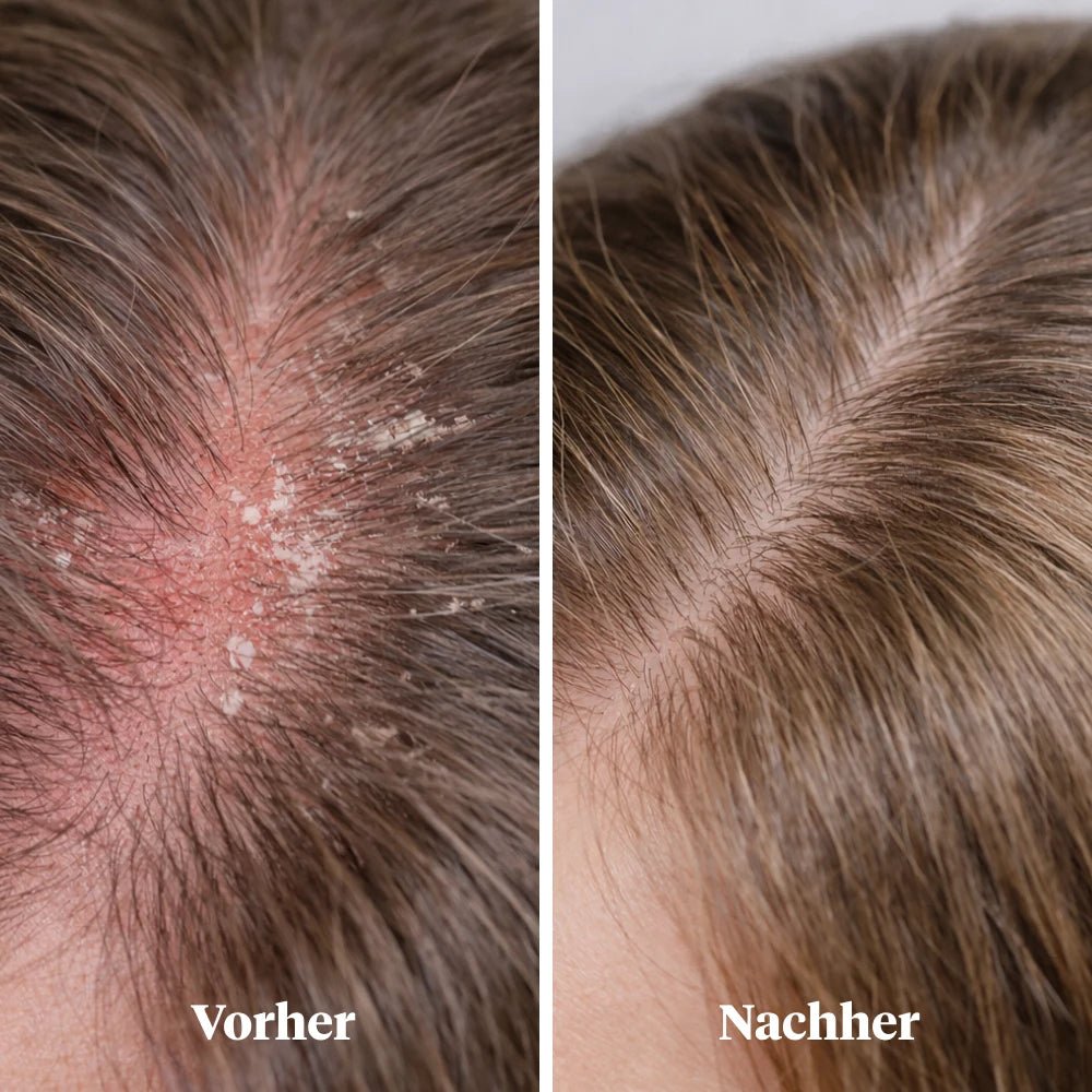 
                  
                    medEctoin® Beruhigendes Kopfhautserum 2% 100 ml
                  
                